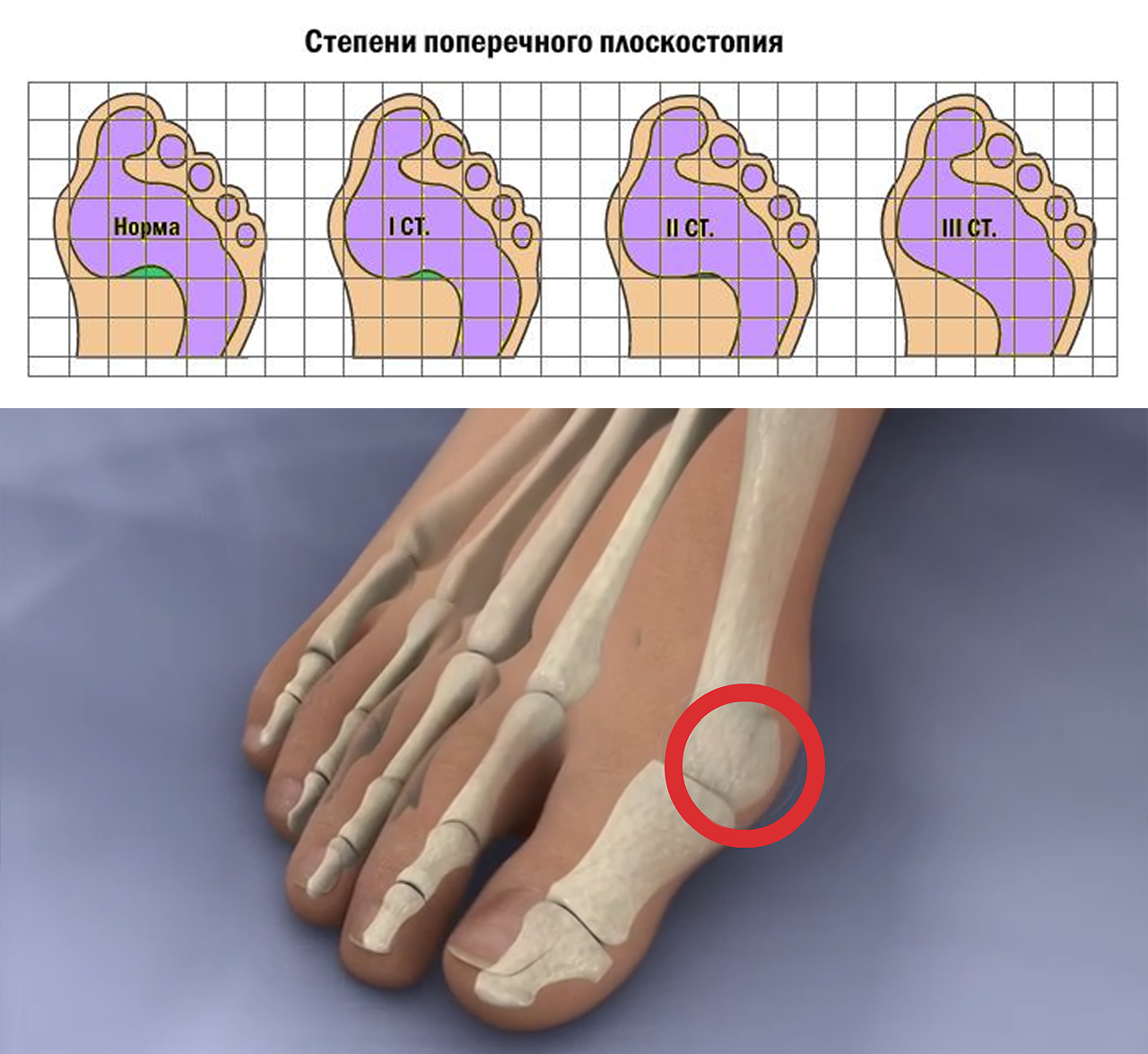 степени поперечного плоскостопия