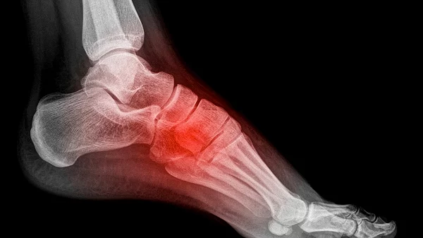Болит стопа после травмы