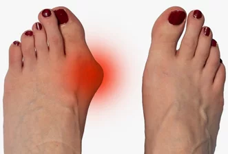 Болит косточка на ноге. Как избавиться от боли?