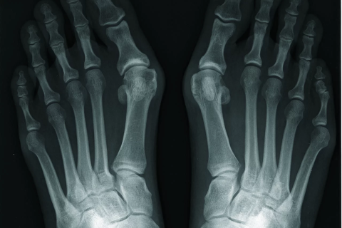 Почему растет косточка на большом пальце?