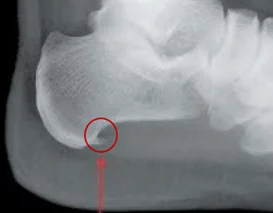 Жгучая боль в пятке в покое и при ходьбе - что это?