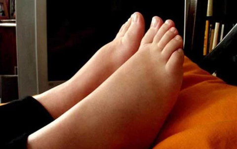 Что делать, если ноги отекают?