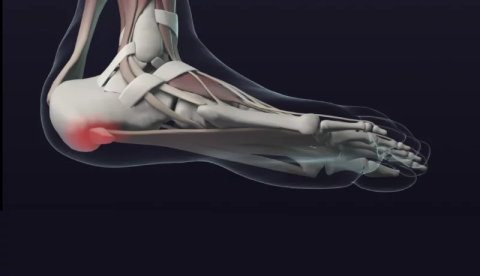 Ортопедические стельки «Антишпора»: эффективное лечение пяточной шпоры.