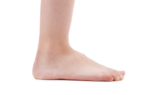 Виды и степени деформаций стопы. Часть 1.