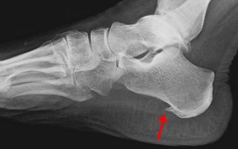 Боли пяток? Надежное средство от пяточной шпоры
